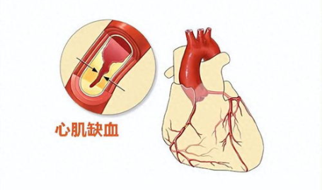 心肌缺血有什么症状和表现,识别早期症状，守护心脏健康